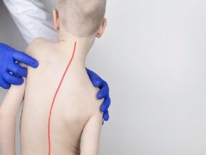 Skolyoz Tedavisinde Gerçek Sanılan 7 Yanlışa Dikkat!